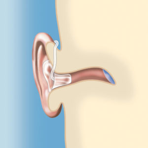 behind the ear hearing aid